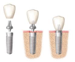 best dental implant clinic in chennai