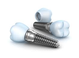 cheapest & best dental implants in Madipakkam