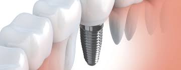 best dental implant centre in chennai
